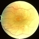 Idiopathic Central Serous Choroidopathy